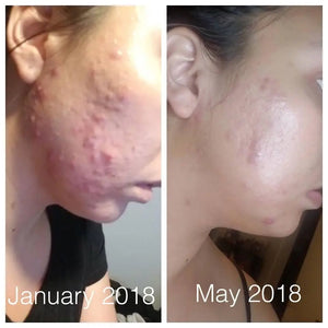 Super Acne Fighter / Organic Acne Treatment / Acne / Essential Oils / - Thrivera