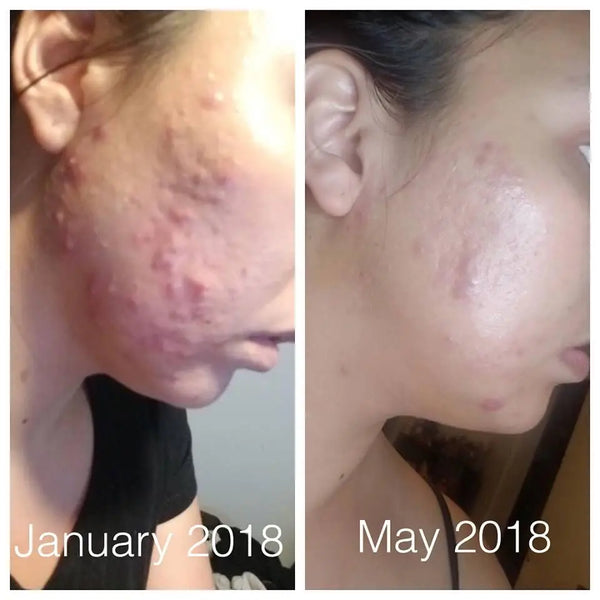 Super Acne Fighter / Organic Acne Treatment / Acne / Essential Oils / - Thrivera