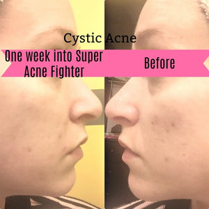 Super Acne Fighter / Organic Acne Treatment / Acne / Essential Oils / - Thrivera