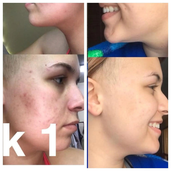 Super Acne Fighter / Organic Acne Treatment / Acne / Essential Oils / - Thrivera